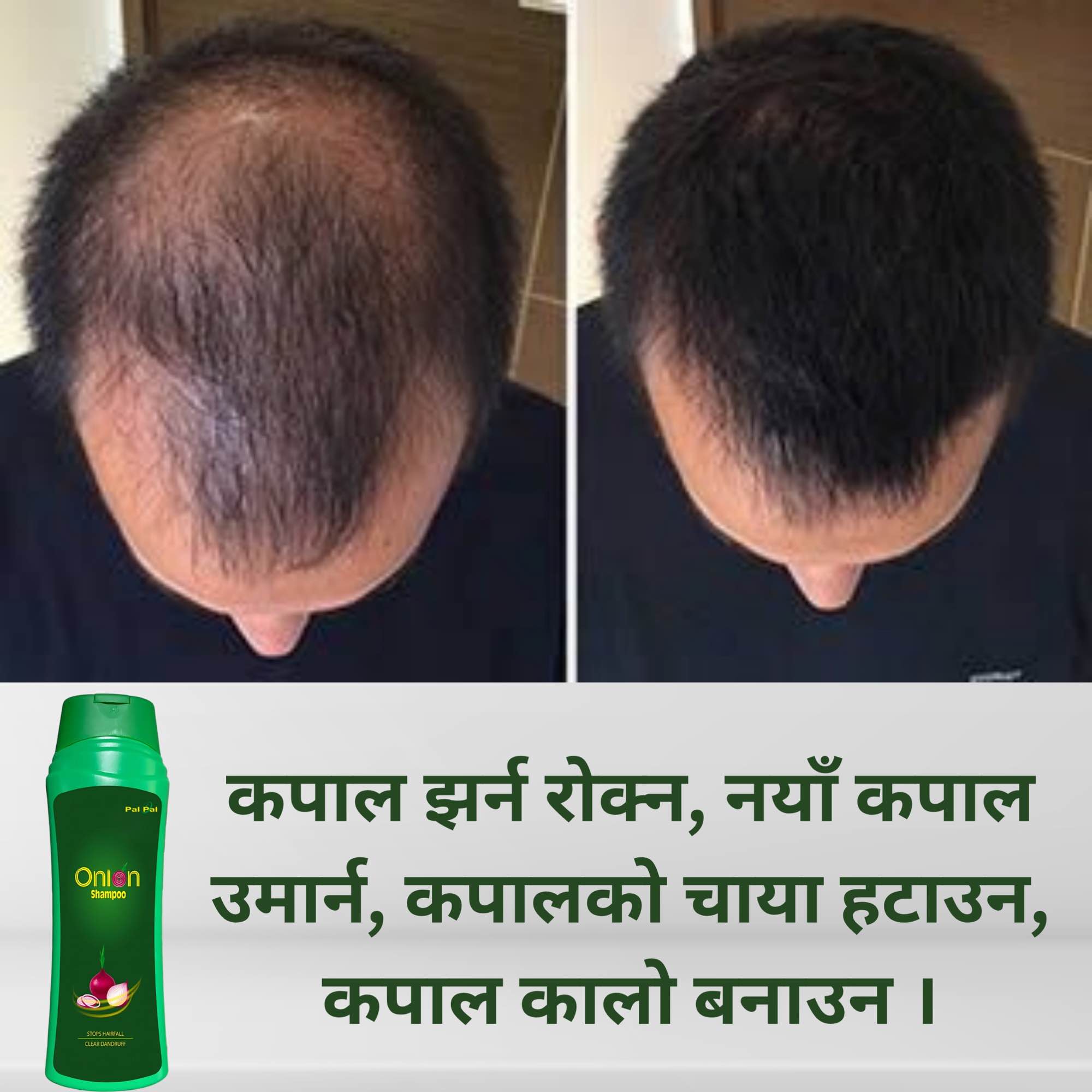Onion Shampoo 350 ml - Clinically Tested & Healthy Product for All Hair Types