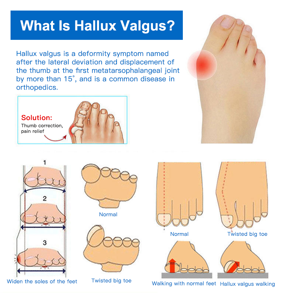 Wenefang Fashion 1Pair Silicone Toes Separator Bunion Bone Ectropion Adjuster Toes Outer Appliance Foot Care Tools Hallux Valgus Corrector