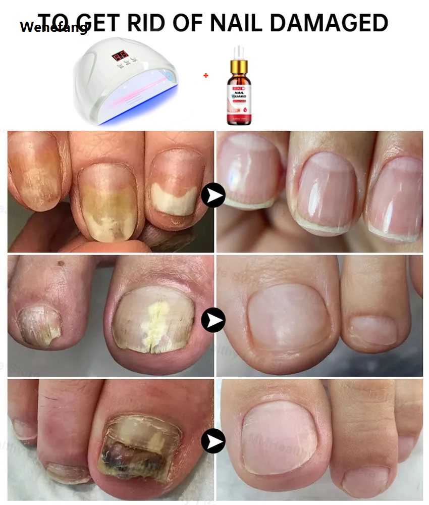 Wenefang Fungal Nail Laser Device Nails Fungus Fast Repair Onychomycosis Toenail Fingernail Removes Nail Fungus Foot Care Cure Ingrown
