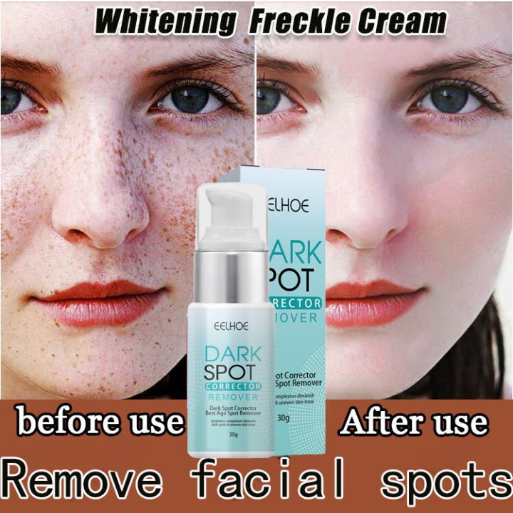 Eelhoe Advanced Dark Spot Corrector Serum (30g) - Powerful Retinol & Niacinamide Anti-Hyperpigmentation Treatment for Melasma, Sun Spots & Acne Scars