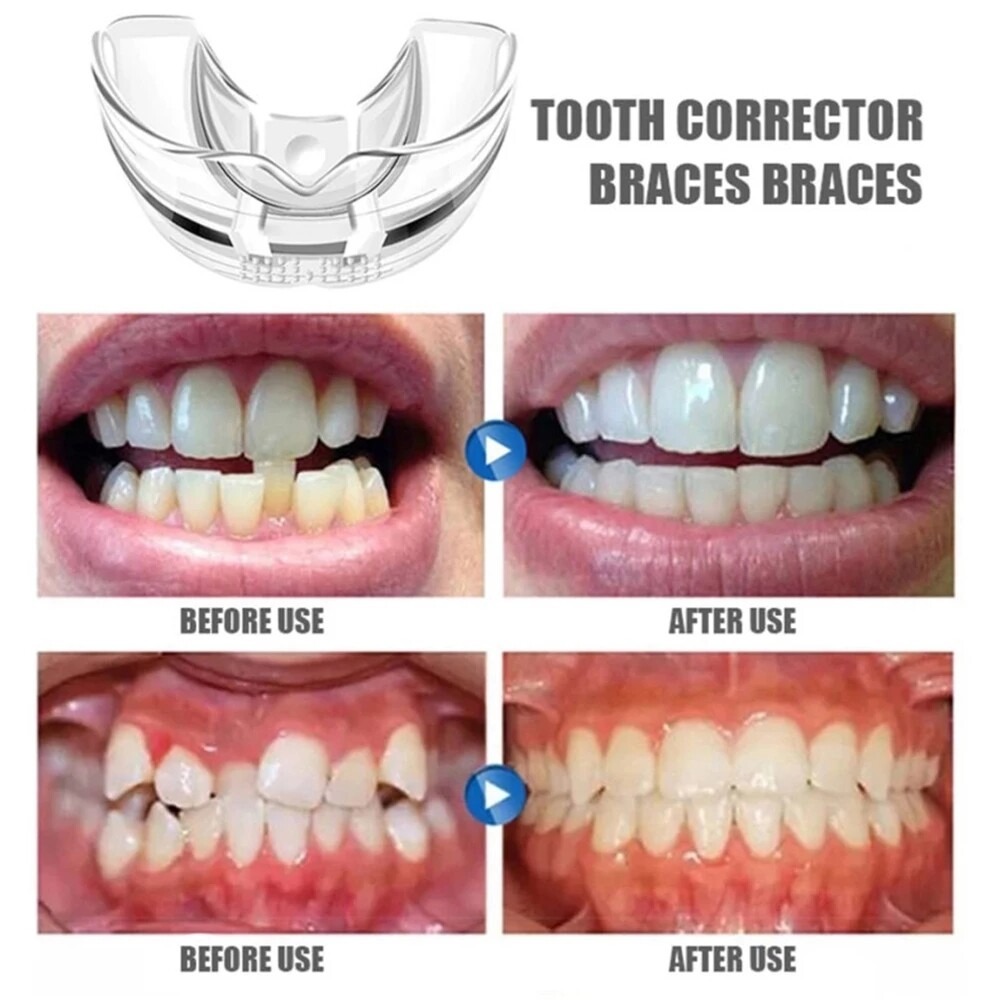 Dental Orthodontic Teeth Corrector Braces Tooth Retainer Straighten Tool